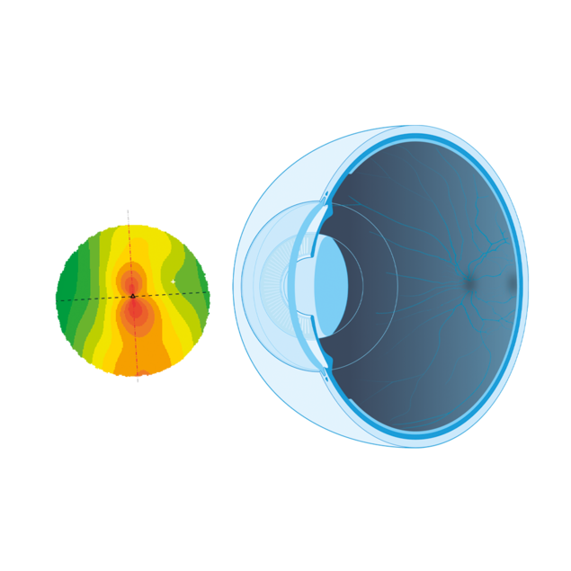 Woman experiences previous 'gush' of fluid from right eye